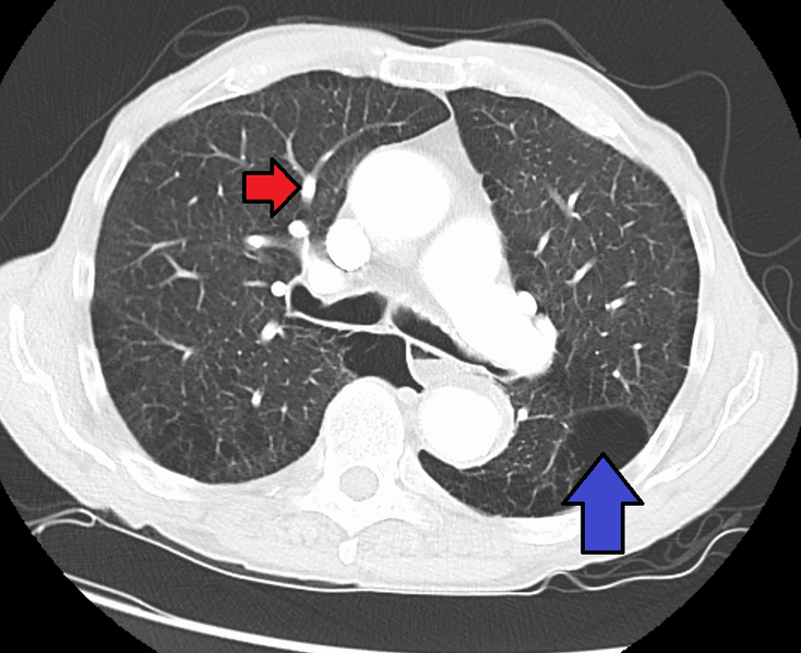 Pulmonary artery hypertension and emphysema as seen on a CT scan with contrast.png