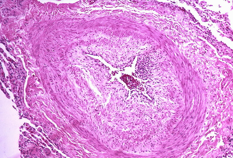 Micrograph showing arteries in pulmonary hypertensive with marked thickening of .jpg
