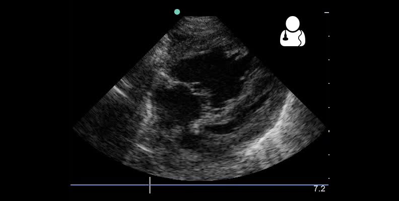 4 month old with pulmonary hypertension as seen on ultrasound[58].jpg