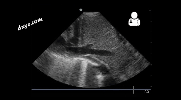 3-4 month old with pulmonary hypertension as seen on ultrasound[58].gif