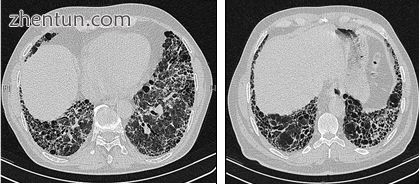 High-resolution computed tomography scans of the chest of a patient with IPF. Th.jpg