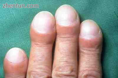 Clubbing of the fingers in idiopathic pulmonary fibrosis.jpg