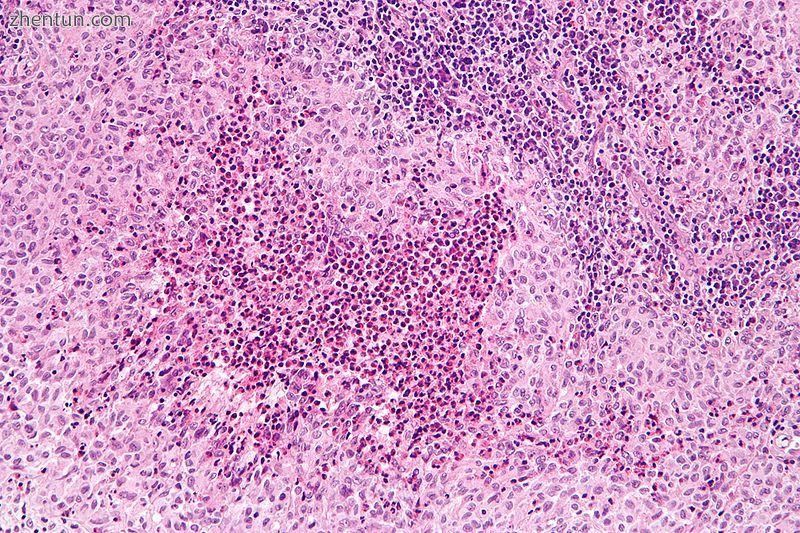 Micrograph showing Langerhans Cell Histiocytosis. H&amp;E stain..jpg