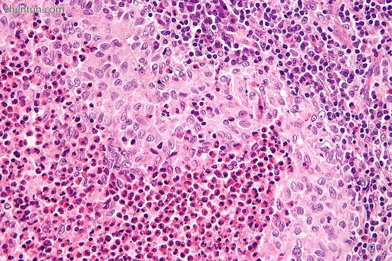 Micrograph showing a Langerhans cell histiocytosis with the characteristic renif.jpg