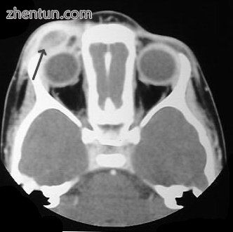 CT scan showing LCH infiltrating peri-orbital tissue (arrowed)..jpg