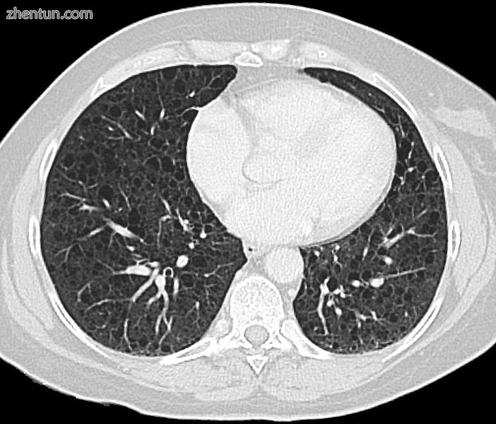 CT scan of the lungs in a patient with lymphangioleiomyomatose showing numerous .jpg