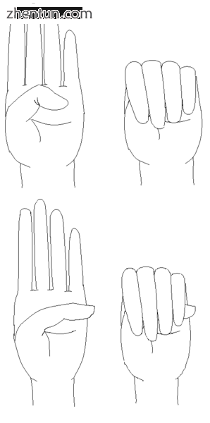 Thumb sign upper normal, lower Marfan syndrome.png