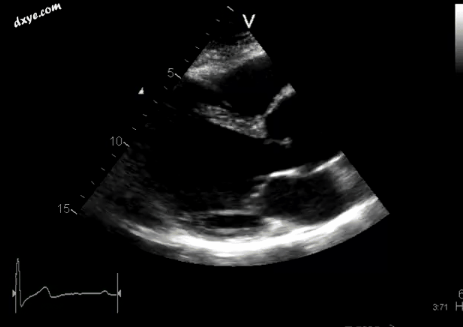 Ultrasound of a person with Marfan syndrome, showing a dilated aortic root.gif