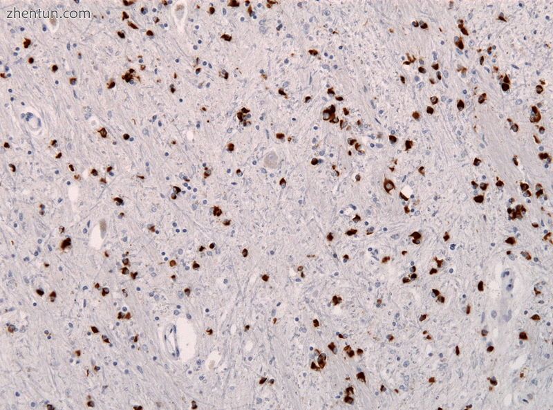 Alpha synuclein immunohistochemistry showing many glial inclusions.jpg