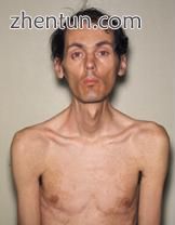 40-year-old with myotonic dystrophy who presented with muscle wasting, bilateral.jpg