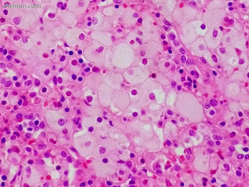 Niemann–Pick cell in spleen.jpg