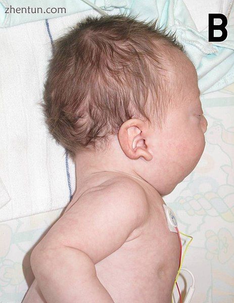 Abnormal features of Noonan syndrome at the age of 3 months. Note low set, poste.jpg