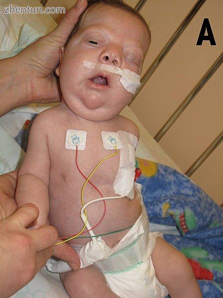 Abnormal features of Noonan syndrome at the age of 3 months. Note eyebrow slant .jpg
