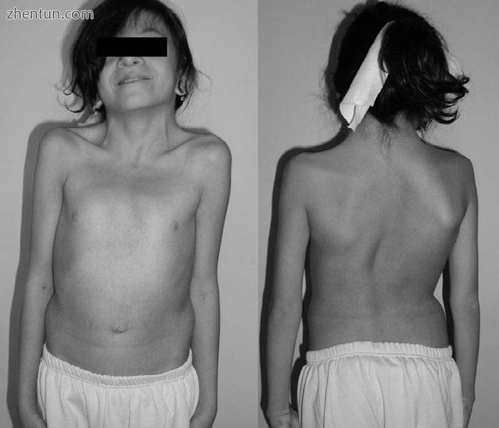 A 12-year-old girl with Noonan syndrome. Typical webbed neck. Double structural .png
