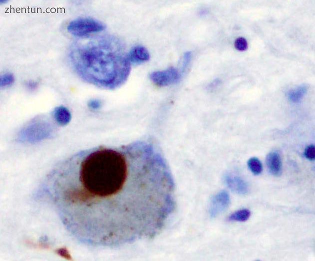 A Lewy body (stained brown) in a brain cell of the substantia nigra in Parkinson.jpg
