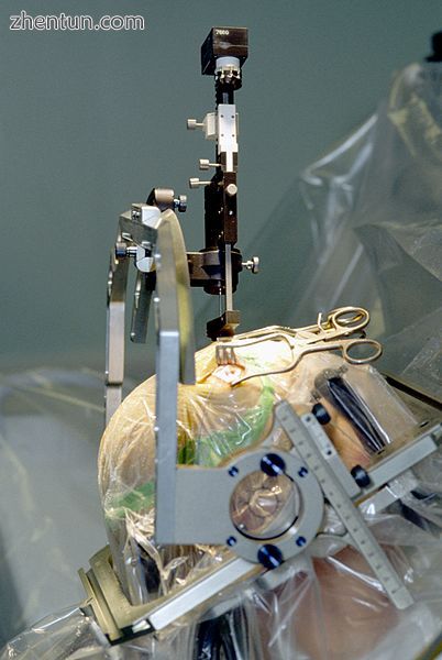 Placement of an electrode into the brain. The head is stabilised in a frame for .jpg