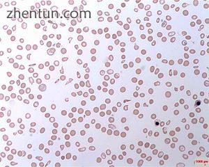 Intravascular hemolytic anemia.jpg