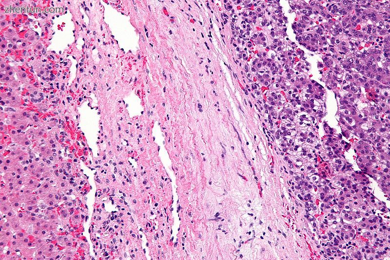 Micrograph showing a hepatoblastoma (right of image) and normal liver (left of i.jpg