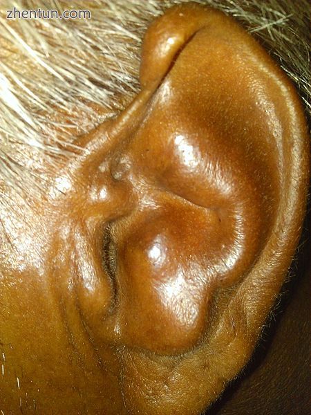 A cauliflower ear deformity.jpg
