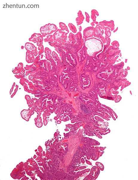 Micrograph of Peutz-Jeghers type colonic polyp. H&amp;E stain..jpg