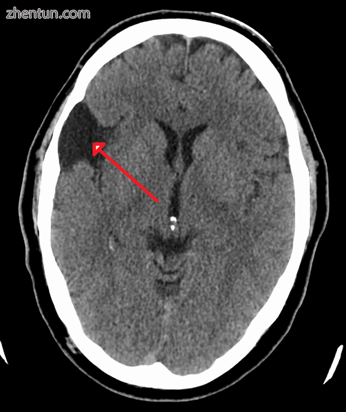 Arachnoid cyst as seen on a CT image of the brain.png