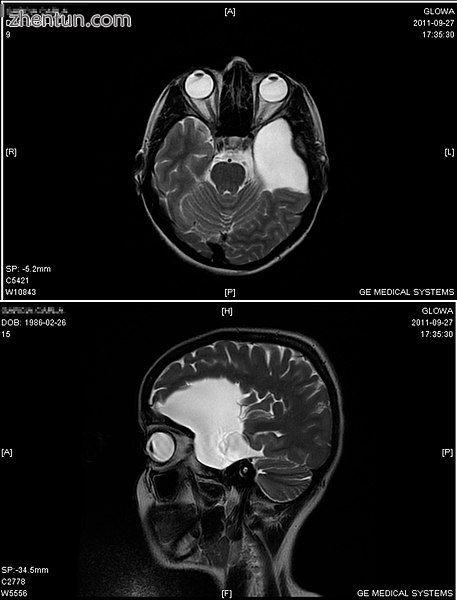 An MRI of a 25-year-old woman with left frontotemporal arachnoid cyst..jpg