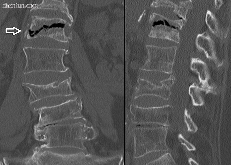 The intravertebral vacuum cleft sign (at white arrow) is a sign of avascular nec.jpg