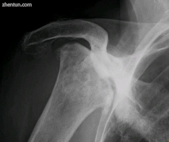 Radiography of total avascular necrosis of right humeral head. Woman of 81 years.jpg
