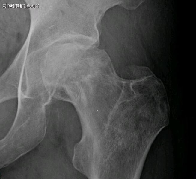 Radiography of avascular necrosis of left femoral head. Man of 45 years with AIDS.jpg
