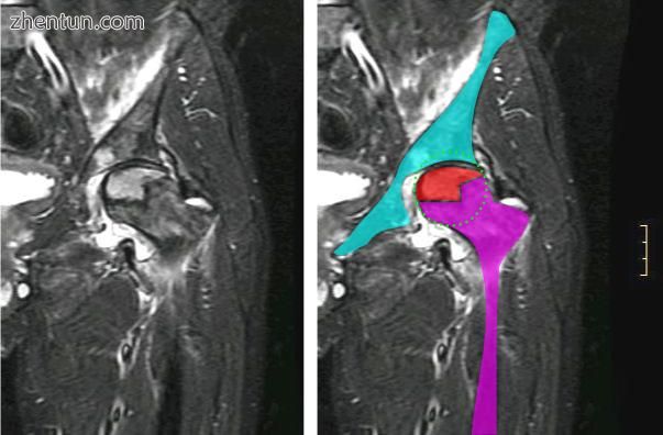 Nuclear magnetic resonance of avascular necrosis of left femoral head. Man of 45.jpg