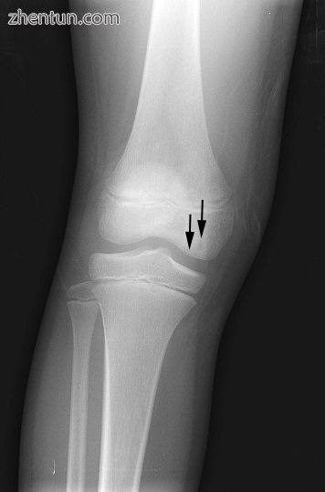 Front X-ray of right knee of an adolescent (epiphyseal plates are open.jpg