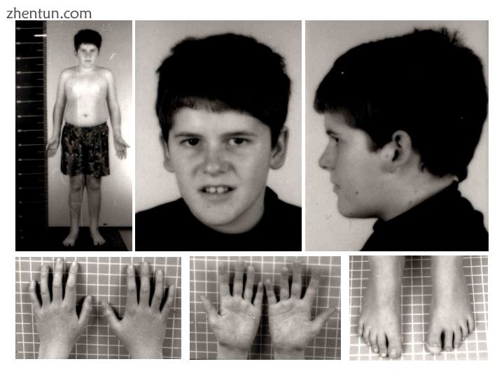 Prader-Willi syndrome phenotype at 15 years of age.jpg