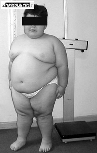 Eight-year-old with Prader–Willi syndrome,[2] exhibiting characteristic obesity.png