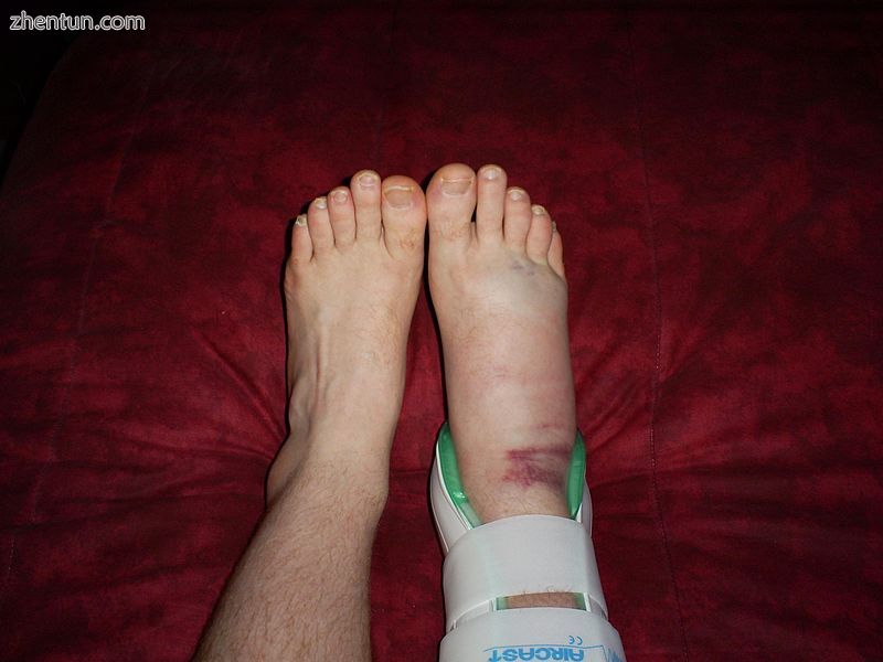 Right foot, housed in an air brace, has become swollen as a result of a more sev.jpg