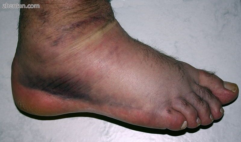 Right foot, 3rd degree sprain. One day after injury..jpg