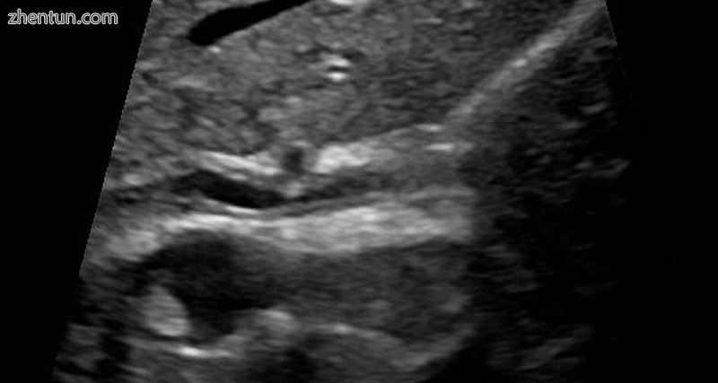 Ultrasound of  sclerosing cholangitis in the common bile duct.jpg
