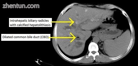 CT scan findings in a case of primary sclerosing cholangitis..jpg
