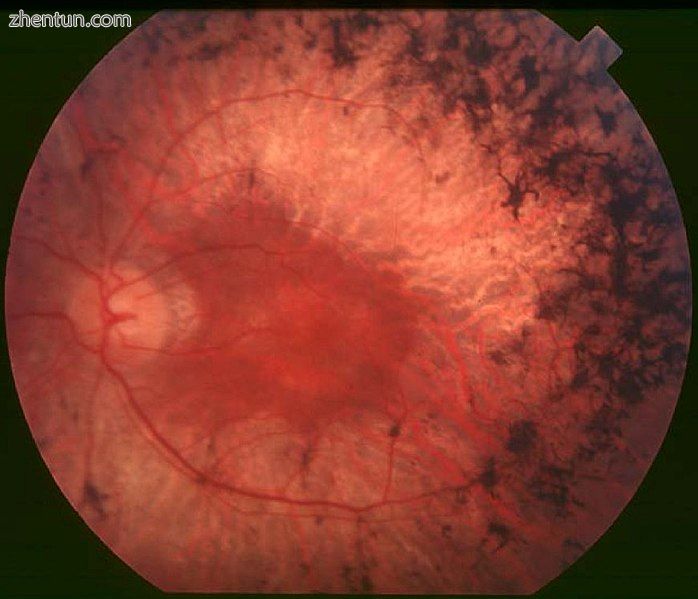 Back of the eye of a person with retinitis pigmentosa, mid stage. Note pigment d.jpg
