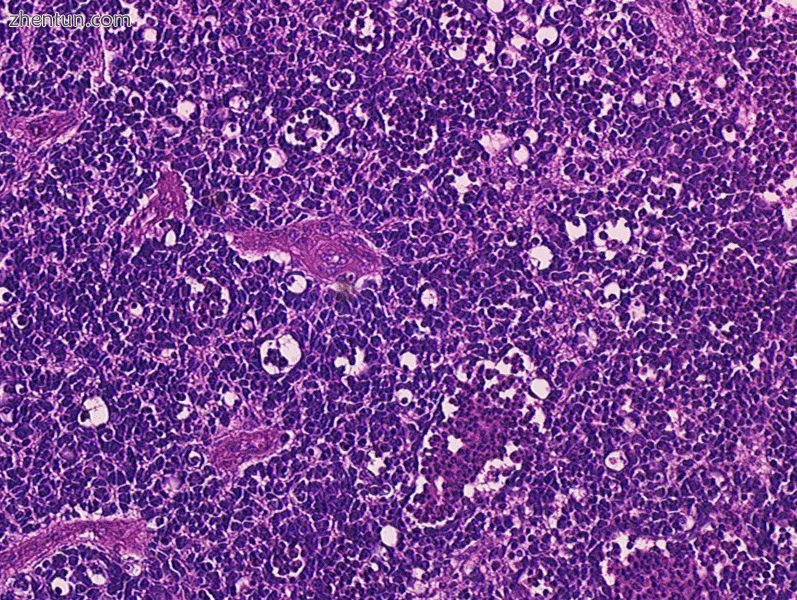 Retinoblastoma, 400 X magnification.GIF
