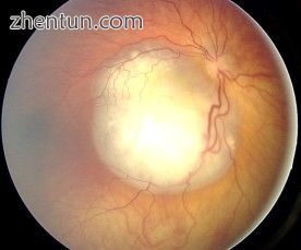 Ocular fundus aspect of retinoblastoma.jpg