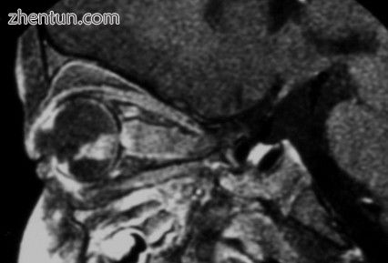 MRI pattern of retinoblastoma with optic nerve involvement (sagittal enhanced T1.jpg