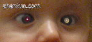 Leukocoria in a child with retinoblastoma.PNG