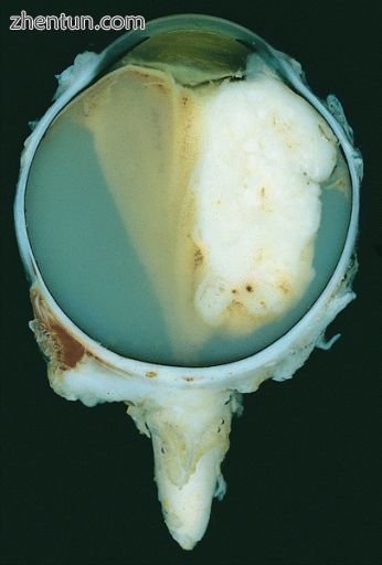 Large exophytic white tumor with foci of calcification producing total exudative.jpg
