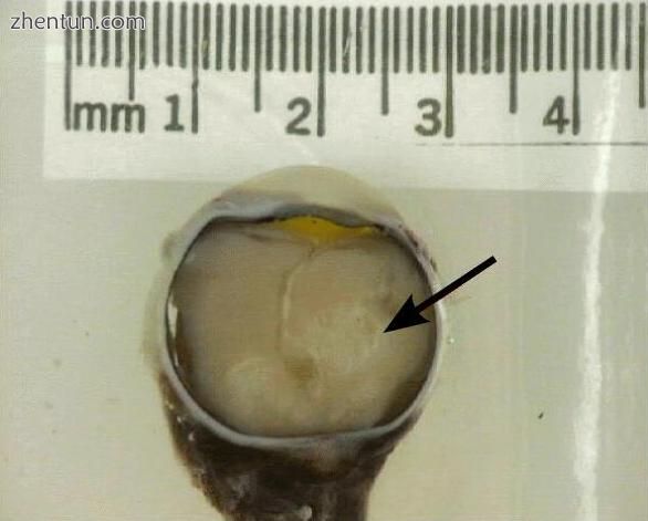 Gross pathology of retinoblastoma tumor in enucleated eye of three-year-old female.jpg