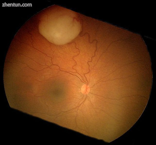 Funduscopic finding of a retinoblastoma.jpg