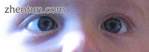 Crossed eyes in a child with retinoblastoma.jpg
