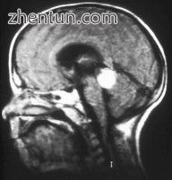 Aspect of trilateral retinoblastoma on MRI.jpg