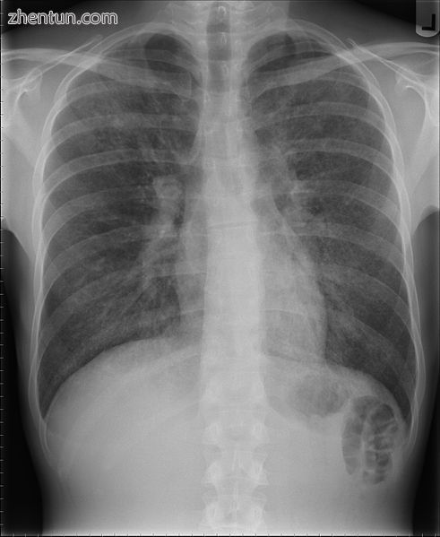 Pneumocystis pneumonia can present with interstitial lung disease, as seen in th.jpg