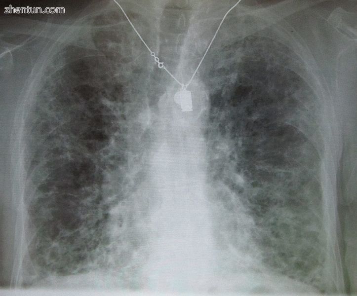 A chest X-ray demonstrating pulmonary fibrosis due to amiodarone.JPG