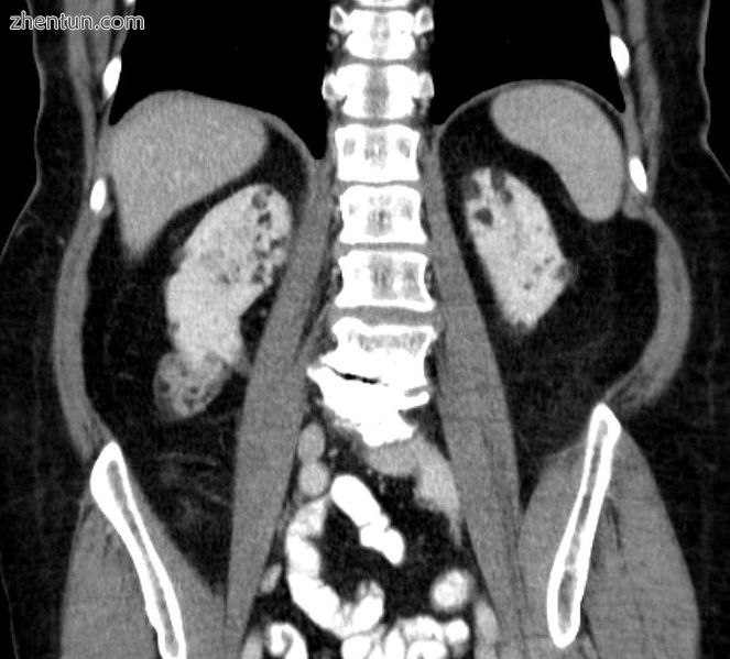 Computed tomography showing multiple angiomyolipomas.jpg